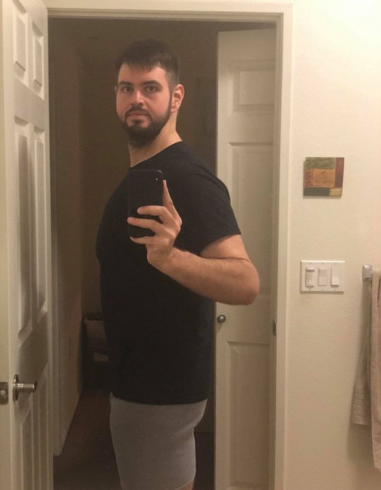 美小伙為愛(ài)減重270斤做手術(shù)去除多余松弛皮膚